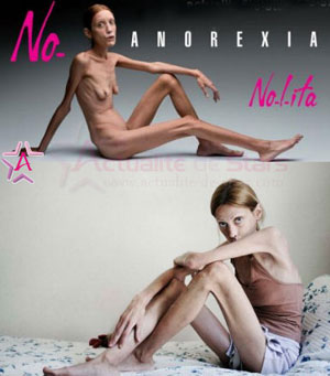 anorexia.jpg